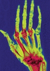 Vitamin D deficiency: Beyond bone health 