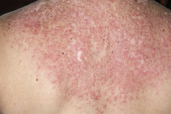 Itching skin and Rash and Systemic disorders - Symptom ...
