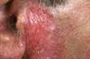 Recognizing systemic lupus erythematosus Recognizing systemic lupus erythematosus