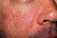 Recognizing Systemic Lupus Erythematosus