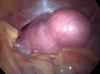 Ulipristal acetate effective for women with symptomatic fibroids 