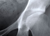 Thyroid hormone and bone density 