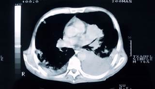 Abraxane approved for some NSCLC Patients Abraxane approved for some NSCLC Patients