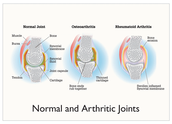 Rheumatoid arthritis physiology