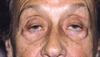 A collaborative approach to myasthenia gravis