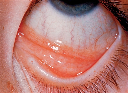 chronic allergic conjunctivitis