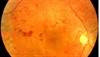 Diabetic retinopathy Diabetic retinopathy