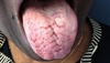 Clinical Challenge: A patient with a 'funny tongue'