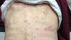 Clinical Challenge: Itchy rash on the trunk
