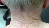 Derm Dx: Exaggerated skin markings on the posterior neck