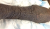 Clinical Challenge: A Woman with 'Mossy' Legs