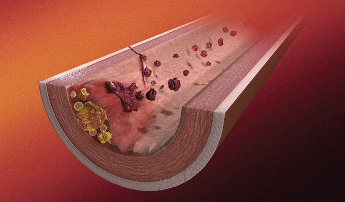 Assessing CVD risk with ankle-brachial index  