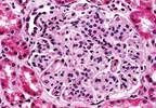 Kidney decline linked with cognitive decline Kidney decline linked with cognitive decline