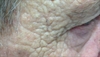 Derm Dx: Wrinkly, yellow skin and blackheads