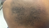 Derm Dx: 'Dirty' skin that cannot be washed