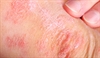 Gluten-free diet or vitamin D supplementation for psoriasis?