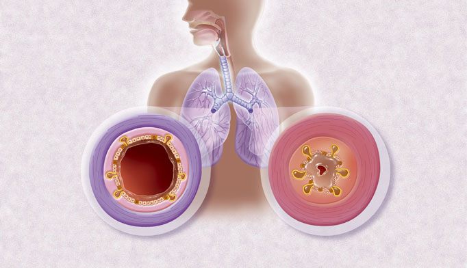 acute-and-chronic-bronchitis