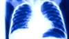 Acute and chronic bronchitis