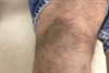 Derm Dx: Bluish-grey skin discoloration