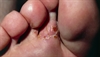 Derm Dx: Vesicles and inflammation on a teenage wrestler's feet