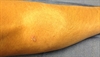 Derm Dx: Hypopigmented patch without sensation
