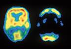 Imaging guidelines issued for Alzheimer disease Imaging guidelines issued for Alzheimer disease