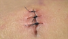 Easing pain during suturing
