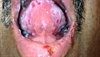 Derm Dx: Mouth rash and painful skin blisters
