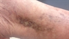 Derm Dx: Whitish scars on ankles