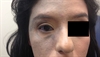 Derm Dx: Blue mark on the face and eye