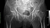No increased delirium with hydromorphone after hip surgery
