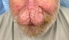 Clinical Challenge: Progressive enlargement of the nose
