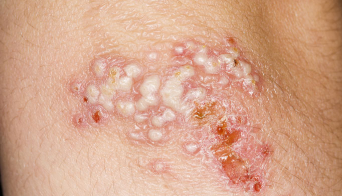 Herpes Buttocks Photos - Dermatology Education