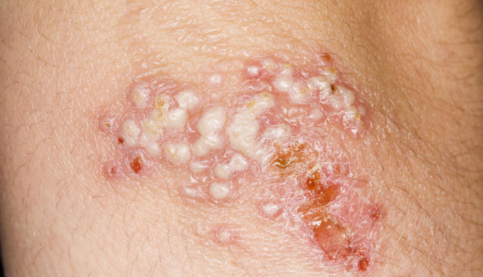 herpetic lesions on buttocks