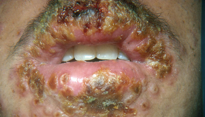 Herpetic Whitlow - Pictures, Treatment, Symptoms, Signs ...