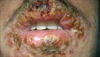 Herpes Simplex Virus 1 & 2