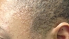 Derm Dx: Pink flat papules on the face