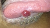 Derm Dx: A red, rapidly growing bump on the tongue