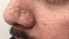 Derm Dx: Small papules on the nose and cheek