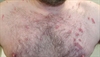Purple trunk plaques on a homosexual man