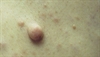Skin-colored papules