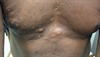 Derm Dx: Multiple cysts on the torso and arms