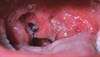 Assessing ­peritonsillar abscesses