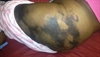 Derm Dx: Painful patches and plaques