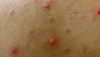 Derm Dx: Itchy blisters with a sore throat