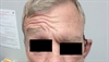 Derm Dx: Droopy eyebrow after surgery