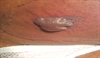 Dusky bullae on the lower abdomen