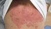 Painful vesicles covering the back and chest