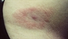 Erythematous plaques on the trunk
