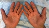 Hyperkeratotic peeling palms and soles after chemotherapy